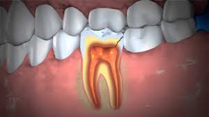 Other than a gum abscess (also referred to as a gingival abscess), there are two other types of dental abscess. Abscess Tooth American Dental Association