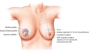 Breast Reduction Before And After In Australia.