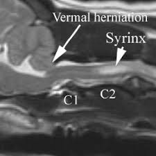 Image result for Spinal Dysraphism