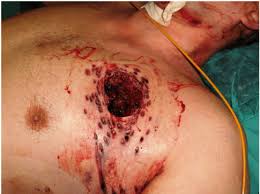 Warning graphic images through and through gunshot wound to the. The Shotgun Vs The Rifle
