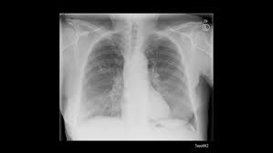 Rontgenbildgebung Bei Covid 19 Patienten