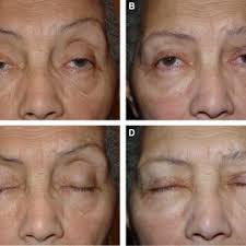 PDF) Bilateral lid/brow elevation procedure for severe ptosis in  Kearns-Sayre syndrome, a mitochondrial cytopathy