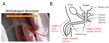 Image result for Urethral Catheterization