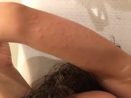 Image result for mite bites on humans