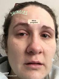 My Painful Journey with Shingles: A Survivor's Story