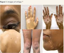Image result for Vitiligo