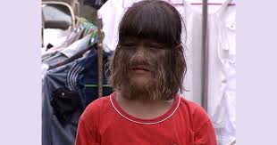 Hypertrichosis, sometimes called werewolf syndrome is a very rare condition, with fewer than 100 cases documented worldwide. Happy Werewolf Girl Says She S Proud Of Being Special