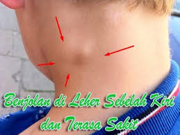 Memang, sebagian besar benjolan pada leher atau pembengkakan di bawah kulit. Benjolan Di Leher Sebelah Kiri Dan Terasa Sakit Sakit Ketika Bernafas Dan Juga Menelan Mohon Simak Disini Hingga Usai Perasaan Penyakit Pernafasan