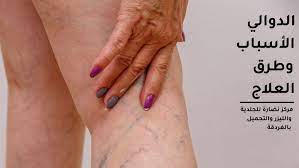 Varicose veins | Causes and treatment methods | Freshness center for  dermatology, laser and cosmetology in Hurghada