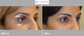 Maybe you would like to learn more about one of these? Eyelid Filler Injection Dark Circles Sunken Eyes Before And After Gallery Taban Md