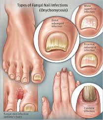 what is toenail fungus mon foot