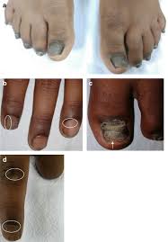 Image result for Pitting nails feet