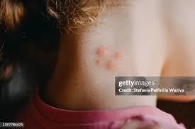 Image result for mite bites on humans