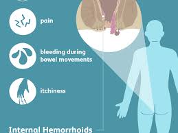 Word «hemorrhoid» translated from greek language means «bleeding», which directly connected with the most prevalent symptom of this. Hemorrhoids Signs Symptoms And Complications
