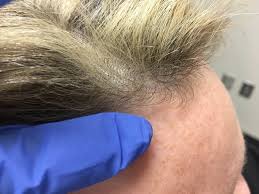 A dermatologist is a doctor who is trained to diagnose conditions that affect our skin, hair. Hair Loss Nashville Dermatologist And Nashville Allergist Blog Traceside Dermatology And Allergy Dermatologist And Allergist In Nashville Tn Blog Traceside Dermatology And Allergy