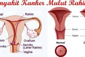 Tanda tanda kanker mulut rahim. Keputihan Bisa Memicu Kanker Mulut Rahim Mitos Atau Fakta Semua Halaman Sonora Id