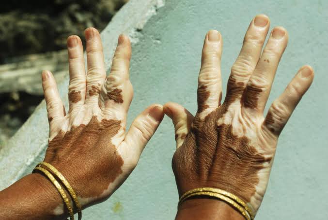 Mga resulta ng larawan para sa Vitiligo or non-segmental vitiligo of the hand"