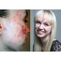 Dulu Diolok Karena Jerawatan, Kini Ikut Kontes Kecantikan