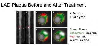 psoriasis therapy can reduce coronary plaque daic