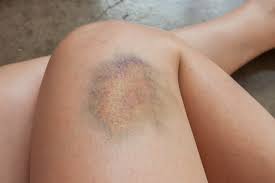 Image result for Pigment stains on the shin