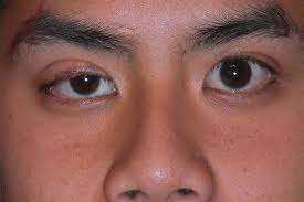 Myasthenia gravis (mg) is an autoimmune disease characterized by weakness and fatigability of skeletal muscles, with improvement following rest. First Covid 19 Then Myasthenia Gravis Coincidence Or Causal Medpage Today