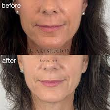 ✨ לעשות זאת נכון: חומצה היאלורונית לשפתיים ✨ גם בגיל מתקדם, לא צריך לוותר  על תחושת הביטחון והיופי שלך! חומצה היאלורונית יכולה להתאים לשפתיים דקות  בצורה טבעית ומרעננת. 💖 הדגש החשוב הוא