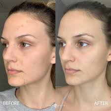 If used daily, dermal repair complex can help you see. Aging Skin Beverly Hills Sun Spot Removal Hollywood Los Angeles