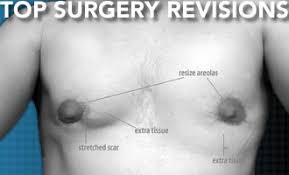 Some companies may require certain materials or a note from a mental. Top Surgery Revisions Stats Causes Costs And Tips