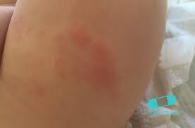 Image result for diaper dermatitis