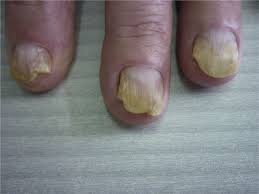 Image result for onychomycosis