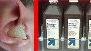 Finish by drying the ear with a clean towel. Hydrogen Peroxide In Ear Hydrogen Peroxide In Ear