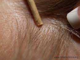 Head Lice