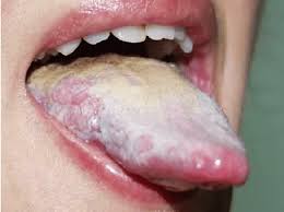 Image result for papillomavirus tongue)
