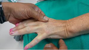 Disi deformity is evident on the sagittal images with dorsal tilt of the lunate and volar rotary subluxation of the scaphoid. Handrehab Wrist And Hand Deformities Kinematics Of The Wrist And Forearm