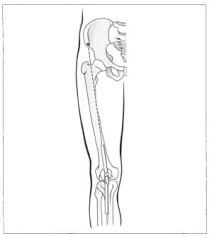 Image result for Ballottable Patella Sign