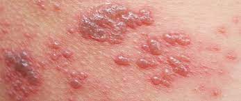 Varicella zoster) هو المسبب الأساسي للحزام الناري. Ø£Ø³Ø¨Ø§Ø¨ Ø§Ù„Ø­Ø²Ø§Ù… Ø§Ù„Ù†Ø§Ø±ÙŠ Ø£Ø¹Ø±Ø§Ø¶Ù‡ ÙˆÙ…Ø¶Ø§Ø¹ÙØ§ØªÙ‡ ÙˆÙŠØ¨ Ø·Ø¨
