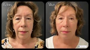 6 week post-op from a lower face & neck lift! Dr. Henry was able to remove  all the excess skin from the neck & lower face, leaving the patient with a  more