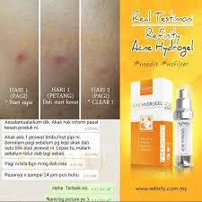 Vitamin e yang dibeli boleh digunakan untuk menghilangkan jerawat memandangkan vitamin e merupakan vitamin penjaga kulit. Refinity Acne Hydrogel Sabah 4 Jenis Ubat Jerawat Yg Anda Perlu Tahu Jika Anda Dah Cuba Macam Macam Jenis Ubat Jerawat Tapi Masalah Jerawat Tak Hilang Hilang Juga Anda Kena Baca Info Ini Sampai