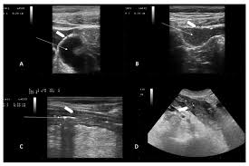 Image result for Neutropenic Colitis