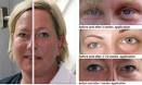 Get rid of bags under eye