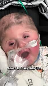 Baby Red Face After Using Nebulizer