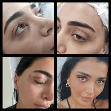 Göz Estetiği basit görünür ama...