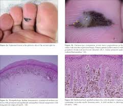 Image result for Spitz Nevus