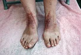 Image result for Stasis Dermatitis
