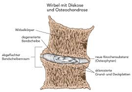 Spondylarthrose Facettensyndrom Stoppen Liebscher Bracht