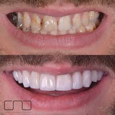 Nouveau Sourire Avec Facettes Et Implants Pour Commencer Cette Semaine Tres Bon Lundi Gadcab Antiaging Beauty Esthetic Implant Bon Lundi Pour Commencer
