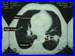 Stage 4c lung cancer, in which cancer has spread to one or multiple. Lung Cancer Adenocarcinoma Of The Lung Healthengine Blog