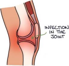 Image result for Septic Joint