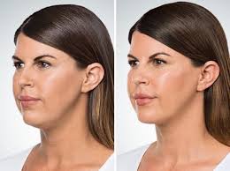 Kybella es una solución no quirúrgica para eliminar la doble papada con  pocas inyecciones. Contiene ácido desoxicólico que se inyecta en el área de  la barbilla. Generalmente destruye las células de grasa