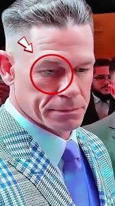 Understanding John Cena's Eye Condition and Health